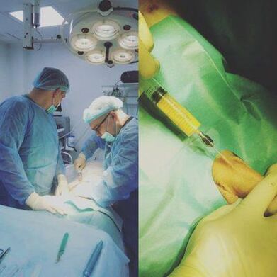 A thickening of the penis is possible with the help of an operation
