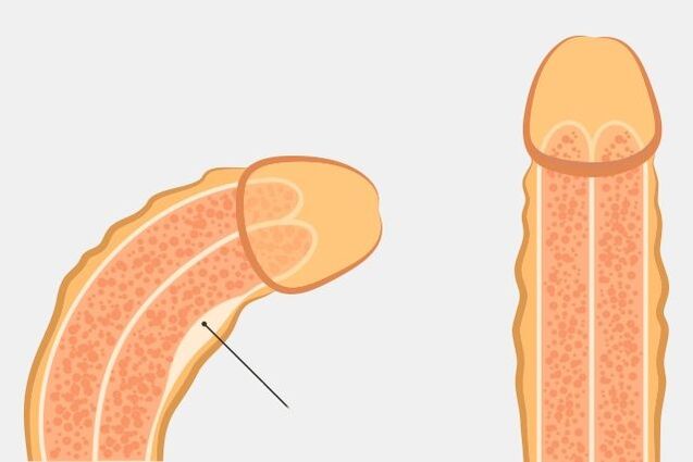 effective way to straighten penis